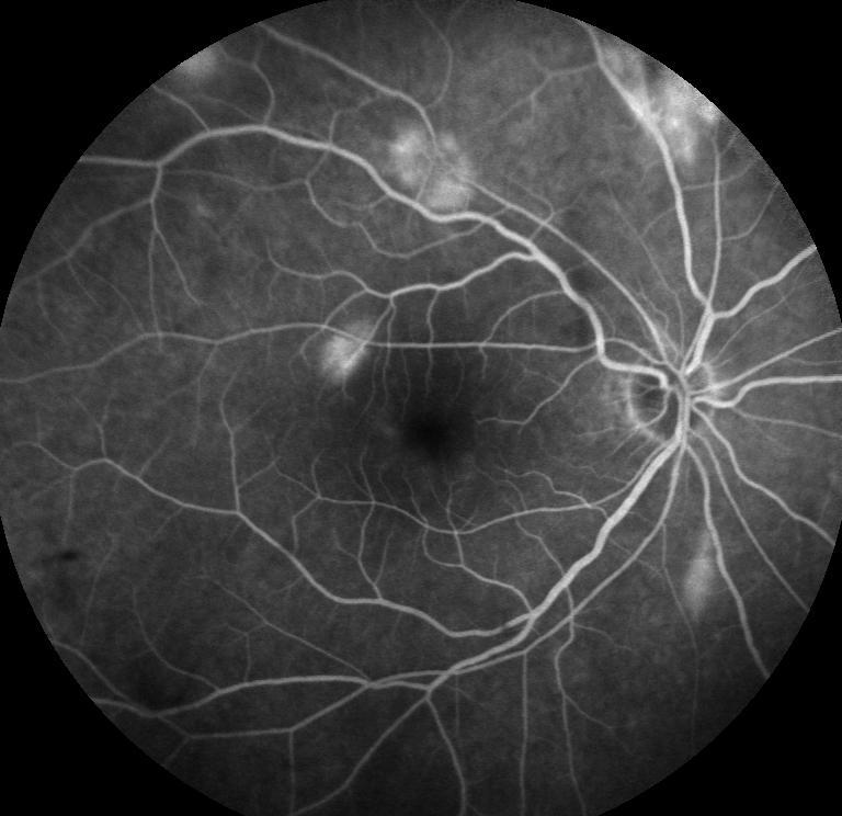The patient subsequently underwent pars plana vitrectomy (PPV) with vitreous washout and endolasers.