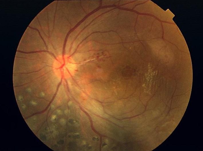 A repeated FFA showed leakage from the telangiectatic vessel near the optic disc and confirmed the cystoid macula oedema (CMO). Patient was subjected for top up PRP along Fig.