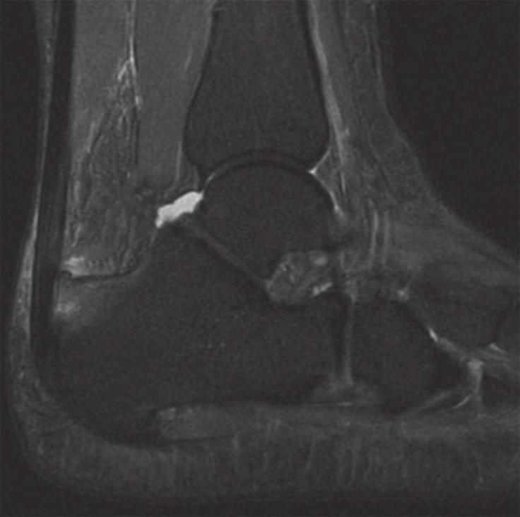 Physical examination revealed a tender, inflamed and indurated posterior heel with an associated visible bony prominence on the posterosuperior aspect of the calcaneus. Lateral ankle radiography (Fig.