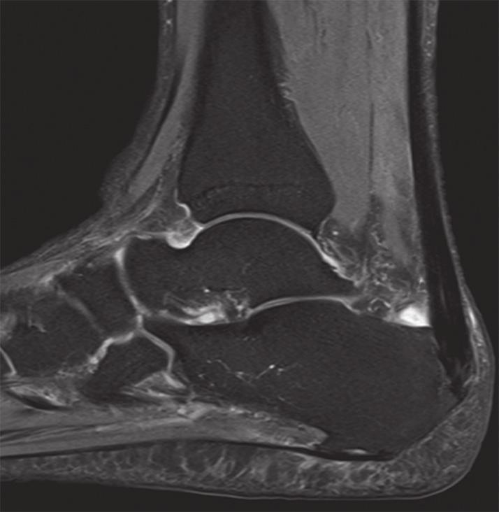 IMAGE INTERPRETATION The lateral ankle radiograph (Fig. 1) shows prominent left posterosuperior calcaneal tuberosity (black arrow) and thickening of the distal Achilles tendon outline (white arrow).