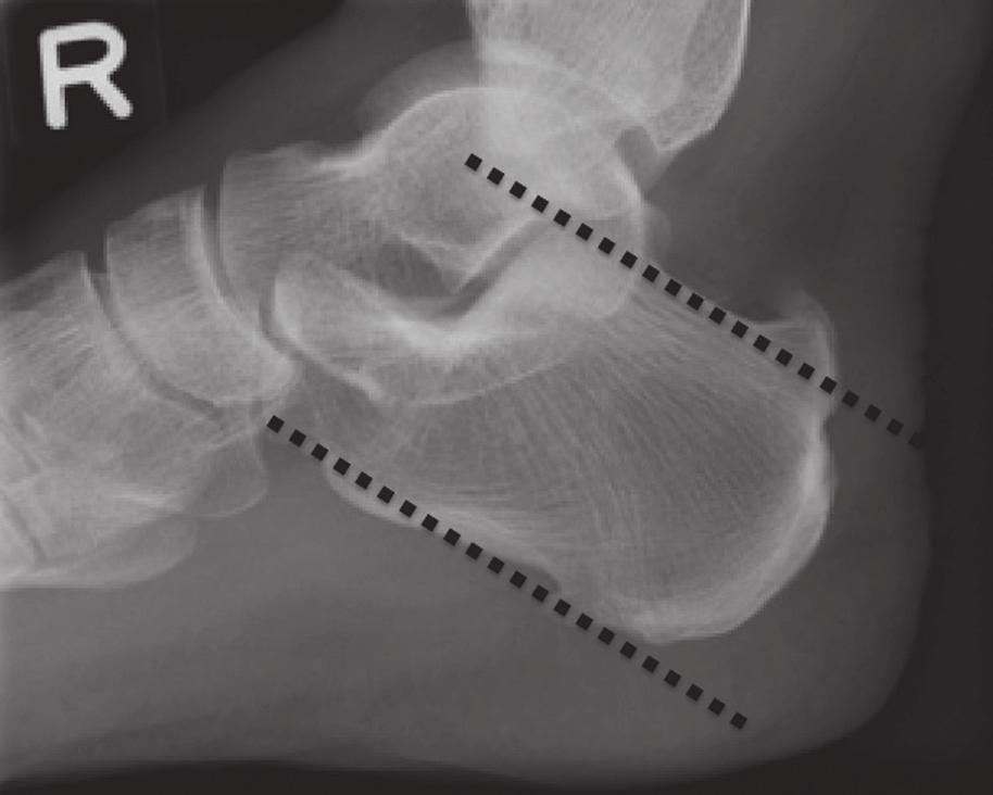 Fig. 4 Right ankle lateral radiograph of a 56-year-old man with hind foot pain shows parallel pitch lines (dotted lines). The bony projection (white arrow) above this line is considered abnormal.