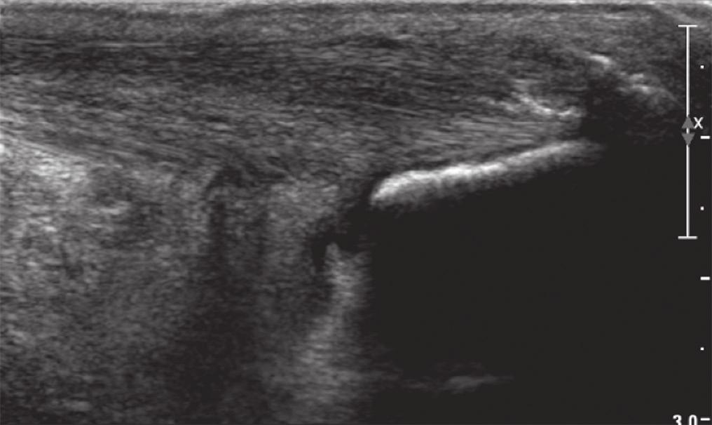 5 (a) Grey-scale and (b) colour Doppler US images of the left ankle (in longitudinal view) in a symptomatic 55-year-old woman with Haglund s deformity shows a prominent posterosuperior bump