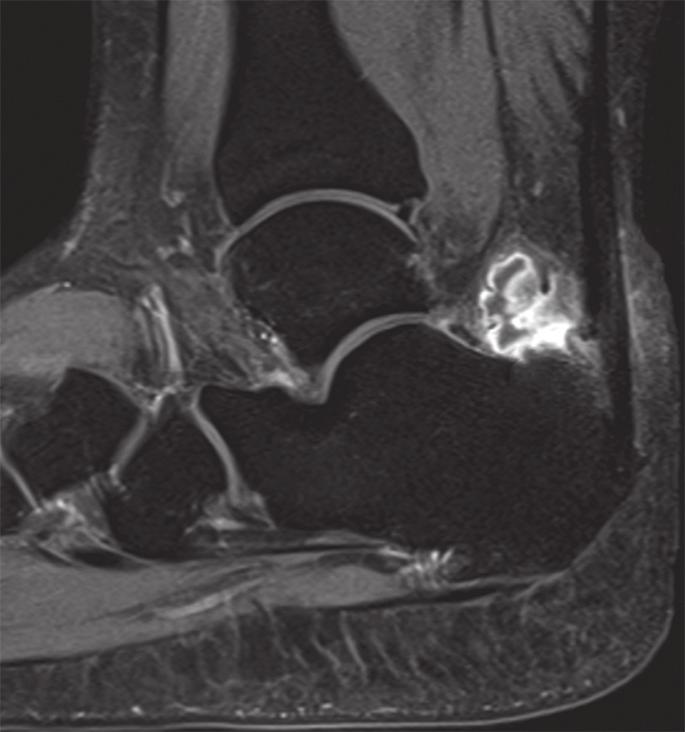 8 (a) Sagittal and (b) axial contrast-enhanced, T1-W MR images of the right ankle in a 33-year-old woman show an enlarged retrocalcaneal bursa complicated by abscess formation.