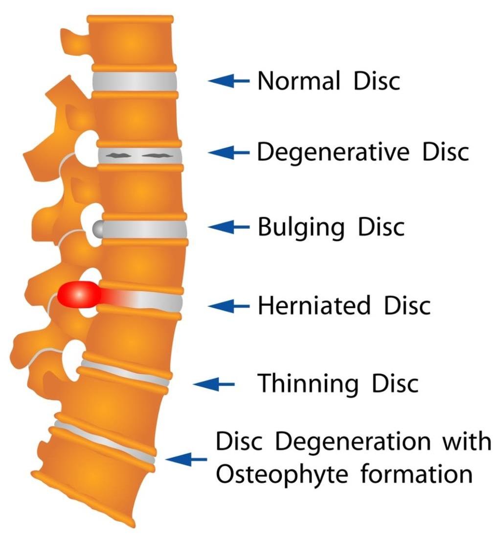 Lumbar Disc Herniation Often asymptomatic May cause back and/or leg pain Most common over 50 (though population