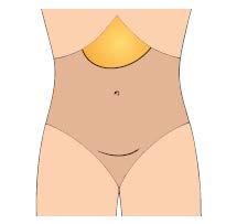 ABDOMINAL PAIN The pain is typically epigastric, often radiates to the back.