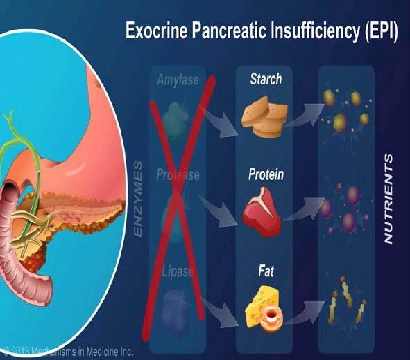 PANCREATIC INSUFFICIENCY Patients with severe pancreatic exocrine dysfunction cannot properly digest complex foods or absorb partially digested