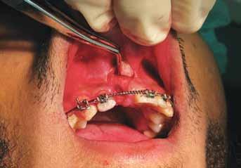 Replacement of Missing Maxillary Central Incisor with an Osseointegrated Implant-supported Prosthesis