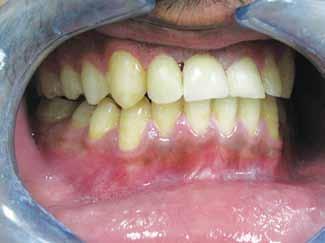 Prathapan Parayaruthottam, Vincy Antony Fig. 14: Post-treatment intraoral photograph with implant-supported crown-frontal view Fig.