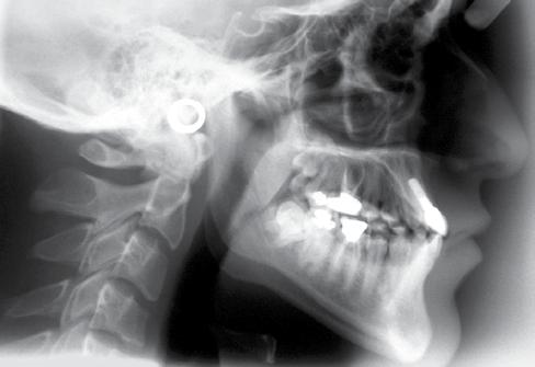 Placing an implant before completion of growth causes a submerged tooth appearance as the implant behaves like an ankylosed tooth and results in a reduced clinical crown length.