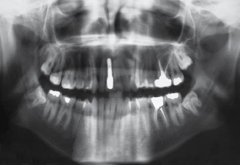 The time of implant placement should be towards the end of orthodontic treatment.