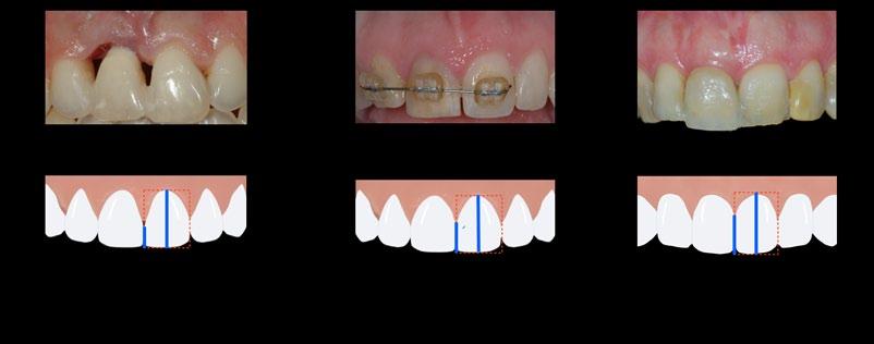Contact Length / Crown Height Ratio R < 43% Triangular 43%< R <57% Square Tapered 57% < R Square Fig 2 Significance of crown shape in the replacement of a central incisor with a single