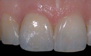 adjacent central incisor, 40% of the square/tapered group required an additional restoration, and 13.