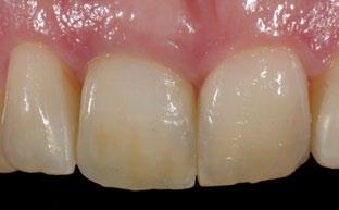 A porcelain laminate veneer with no tooth preparation was added on the maxillary left central incisor in order to close the initial diastema.