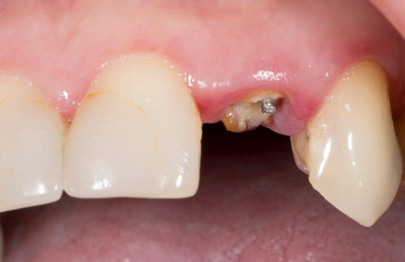 Patient 1 Upper lateral incisor replacement The patient presented to the