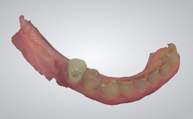 piece construction with integrated abutment.