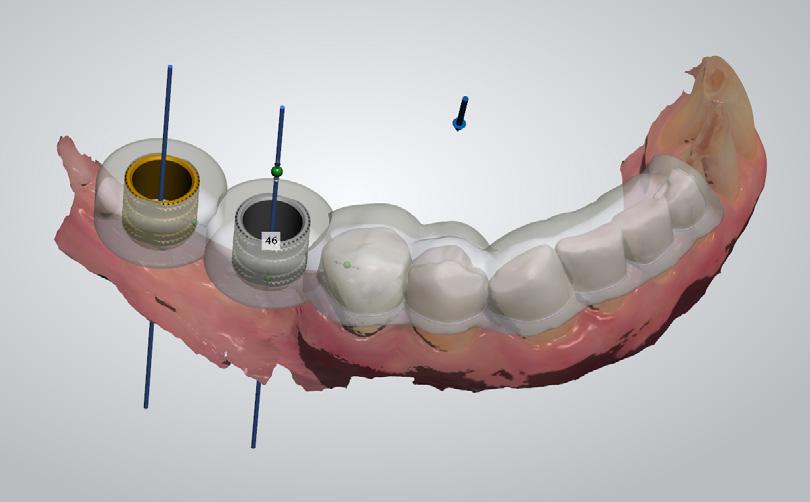 RNI implants. The 46 with the 5.