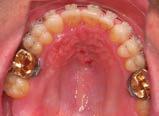 After completion of these sgittl tooth movements, which require high degree of nchorge, the cse cn e finished with lil or lingul fixed pplinces or, when fesile, with ligners.