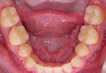 ***Trdemrk of Americn Orthodontics, Sheoygn, WI; www. mericnortho.com.