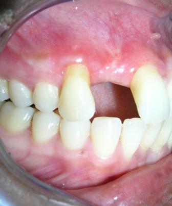 Research & Reviews: Journal of Dental Sciences CASE PRESENTATION A 34-year-old female was referred to the dental OPD with a complaint of missing maxillary right central incisor.