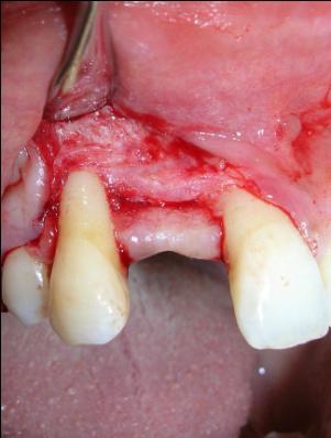 The buccal incision consisted of a full-thickness flap elevation continued to expose the crestal buccal bone followed by a partial thickness flap design made around the crown of the adjacent teeth