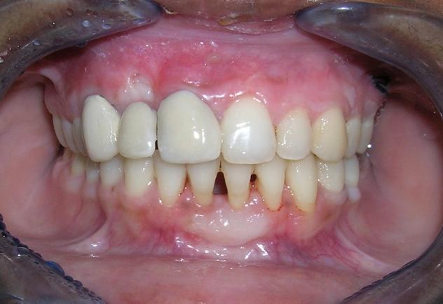 Tooth preparation and prosthetic rehabilitation was carried out which resulted in a good emergence profile and a highly satisfactory esthetic outcome was achieved.