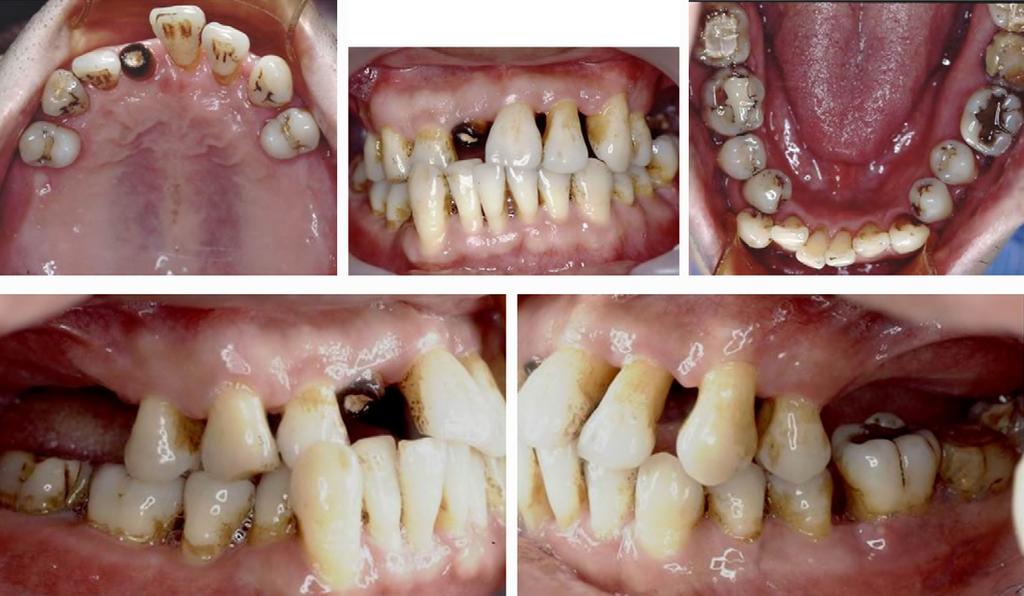 Orthodontic-prosthetic implant anchorage 177 implants during orthodontic treatment, which made it difficult to predetermine the exact locations of the implants.