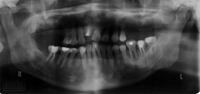 Case presentation The patient was a 45-year-old man whose chief concern was significant decay of the maxillary right central incisor and many missing teeth.
