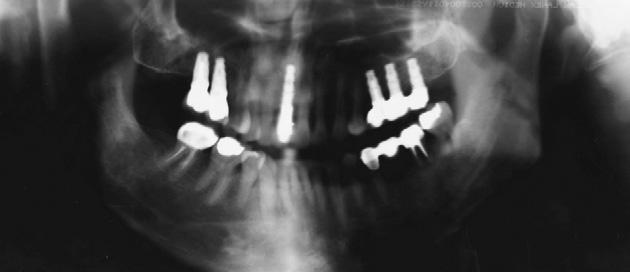 Bilateral Class I canine relationships with a normal overjet and overbite were achieved after treatment (Fig. 7).