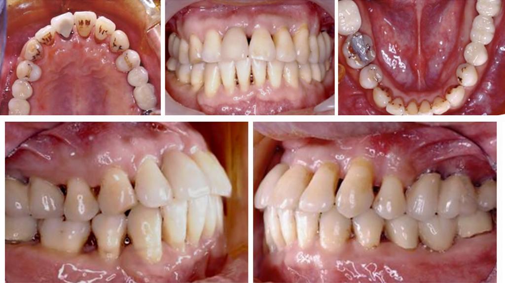 5 Two primary treatment objectives for the patient were to correct the maxillary dental midline and regain space for the maxillary right central incisor.