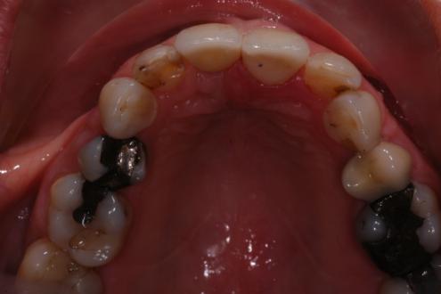 21 abutment torqued to 35Ncm, access cavity sealed with PTFE tape and both crowns cemented with Rely X resin