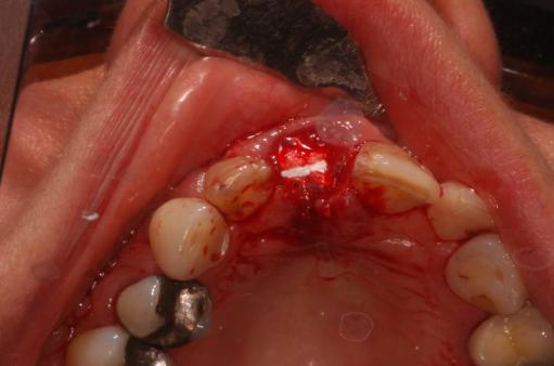 Bio-Oss Collagen block placed into socket as preservation