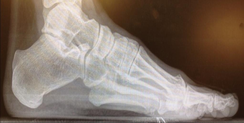 Figure 4: Lateral Patient was diagnosed with hallux limitus and decision was made to proceed with a