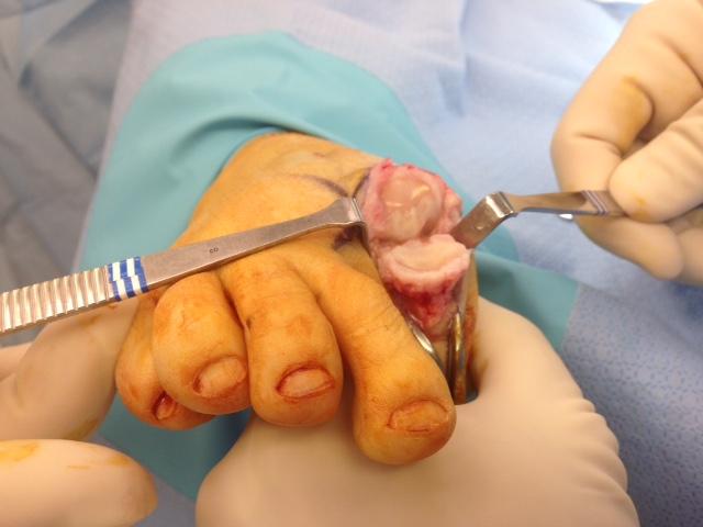 The following images are intra operative photos of the Bio Pro hemi implant in Figures 5-9.