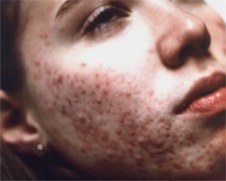 . Acne is a skin disorder in which pores are clogged with oil and germs.