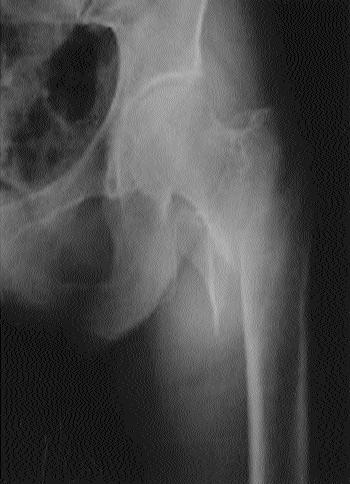19 A B Fig 4-A Preoperative of 67 years old female, Evans