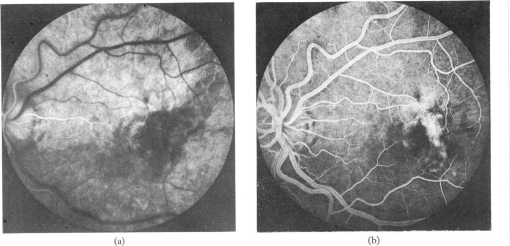 366 British Journal of Ophthalmology (a) (c) months afterwards there was retinal scarring involving the macula with further progression of pigmentary disturbances at the posterior pole (Fig. id).