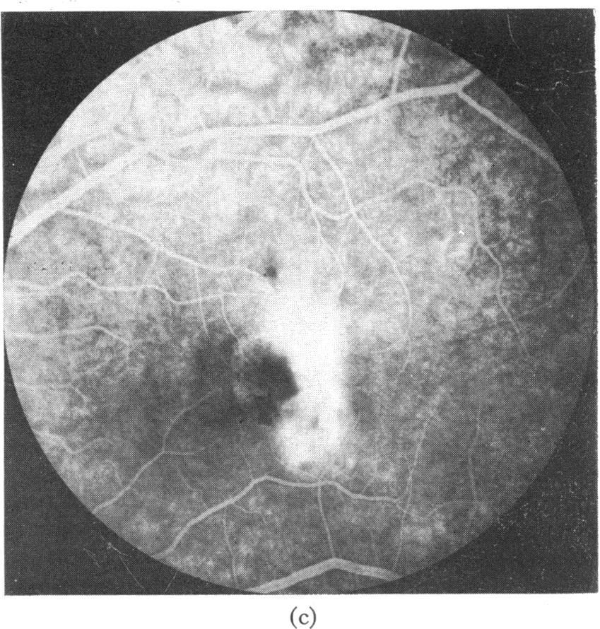 pigmented lesion with no abnormality of the overlying retinal vessels. In the venous and late phases there was progressive uptake of dye in the central area of the mass (Fig. za, b, c).