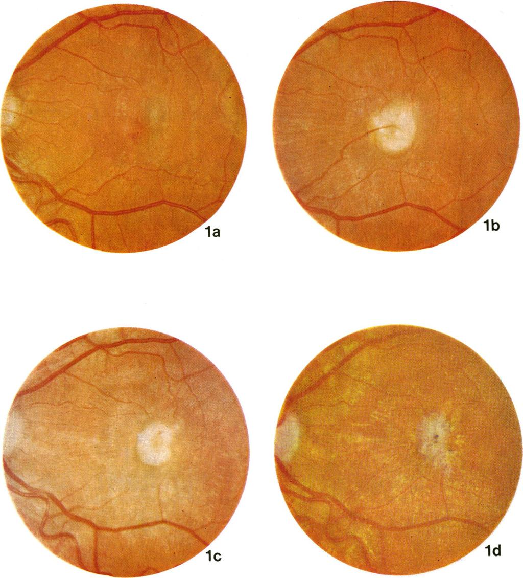 Ocular toxocariasis in adults 367 FIG. I Case I. Changes in appearance of left posterior polar lesion involving the macula. (a) On presentation. (b) After I5 months. (c) After 27 months.