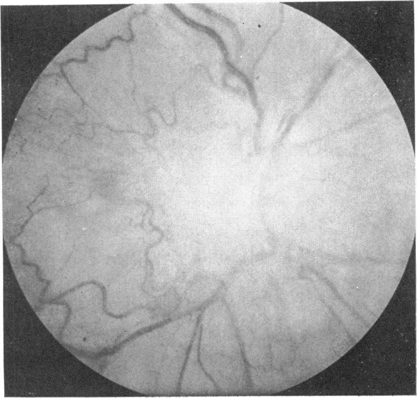 368 British Journal of Ophthalmology FIG. 3 Case i. Left retinal fluorescein angiograms at 40 months. (a) Early arterial phase. (b) Residual angiogram.