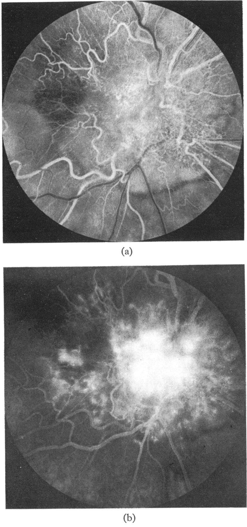 Although the mass appeared flatter than on presentation pigmentation of the retina continued to progress.