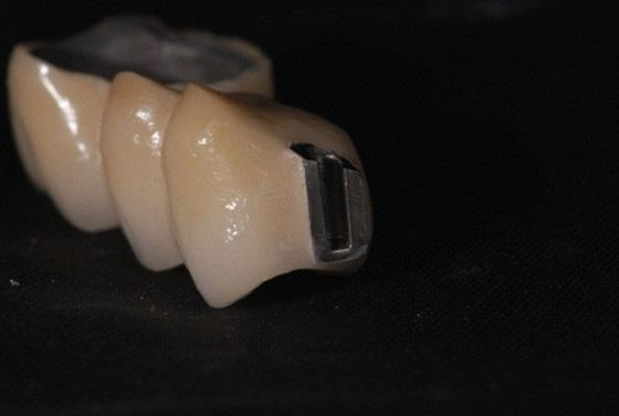 Case Report The dentist was approached by a patient for fixed replacement of the missing teeth in the upper
