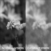 blindness Cataracts Most common cause of vision loss in people over age 40 Mild to Moderate Blur Increased Light Sensitivity and Glare