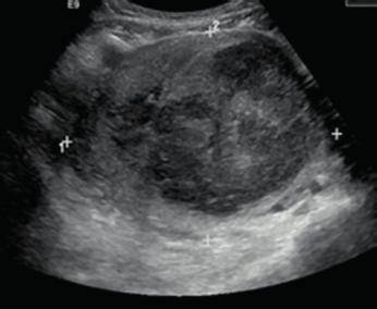 to bladder, no Ascities (Figure 3). Both ovaries were normal and were laterally placed. Saline washing was sent for Cytological examination.