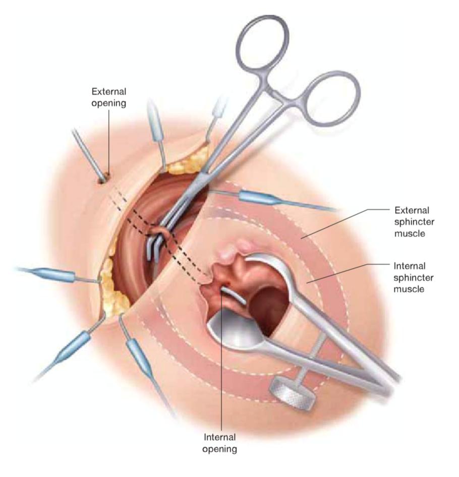 Ligation of the Intersphincteric Tract (LIFT) Originally proposed in 2007 1 Varying success rates (50-94%) 2 Few comparative studies of LIFT vs Endorectal Advancement Flap (EAF) No studies describing