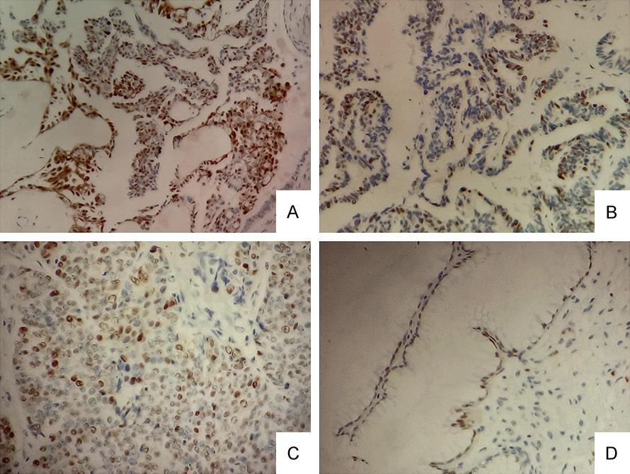 Figure 1. Immunohistochemical staining for CyclinD1: A. Strong positive staining of CyclinD1 in serous carcinoma ( 200). B. Faint staining of CyclinD1 in mucinous carcinoma ( 200). C. Moderate staining of CyclinD1 in endometrioid carcinoma ( 200).