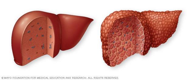 Hepatorenal syndrome Can occur in acute or chronic liver disease of any cause Usually