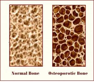 Osteopenia Is a decrease in bone mass. If it is untreated it could lead to osteoporosis.