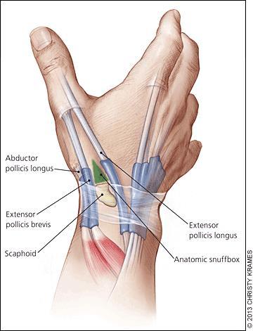 Scaphoid Fracture Signs and Symptoms Swelling Pain in