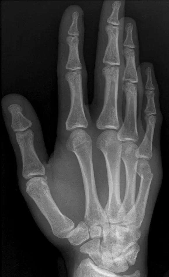Metacarpal Shaft Fractures Direct axial or compressive force 5th metacarpal fractures