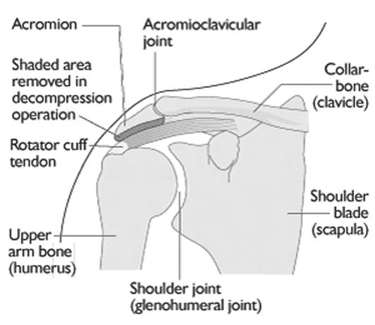 A subacromial decompression may be necessary to relieve the symptoms.